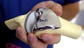 Knee joint replacement